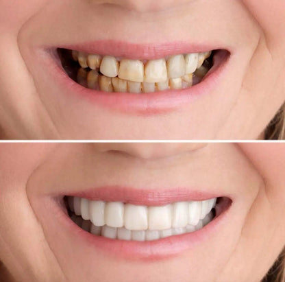 Łatwy Uśmiech - Górne + Dolne Białe Zęby Ana 1